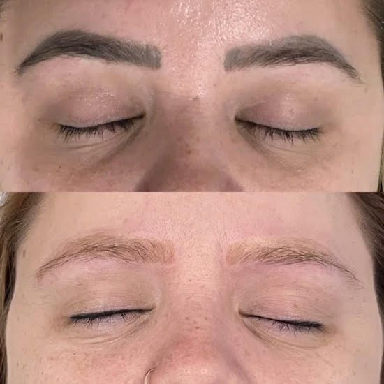 Remoción de Cejas