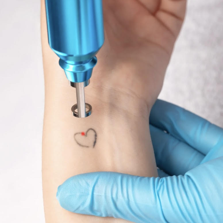 Remoción de Tatuajes Pequeños