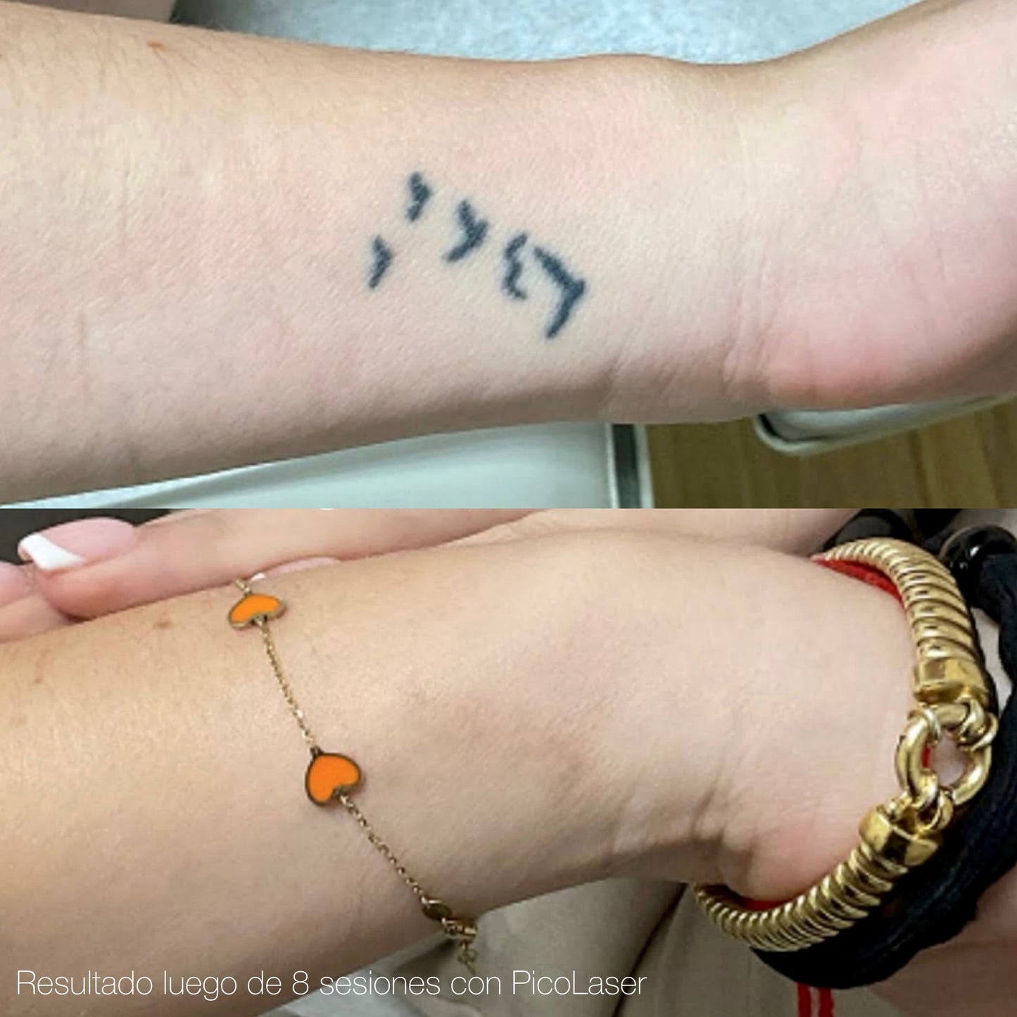 Remoción de Tatuajes Pequeños